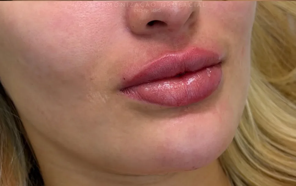 Preenchimento labial com contorno, volume e hidratação after