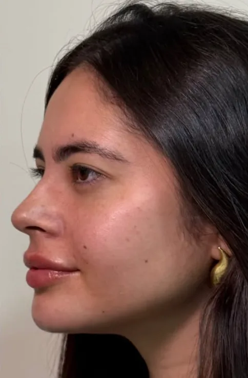 Perfil transformado com a perfiloplastia after