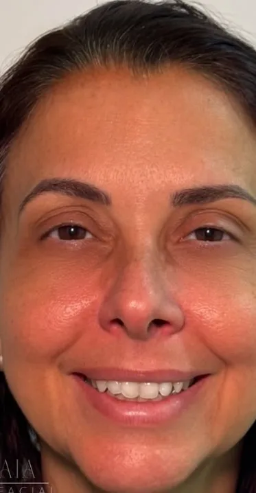 Tratamento pra rugas e qualidade de pele after
