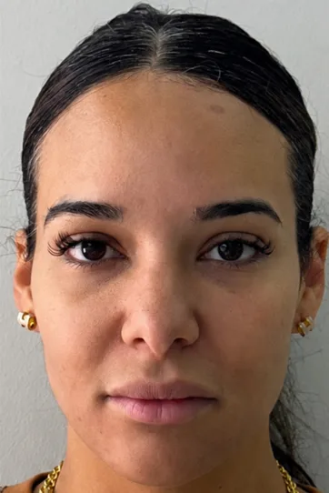 Rejuvenescimento Facial com Full Face before