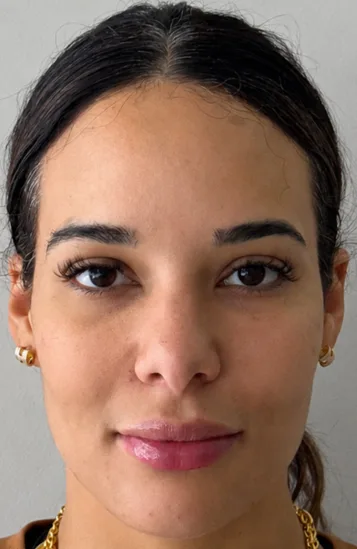 Rejuvenescimento Facial com Full Face after